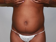 Liposuction Before Photo by John Menard, MD; Tuscaloosa, AL - Case 35926