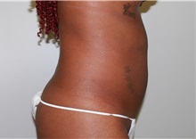 Liposuction After Photo by John Menard, MD; Tuscaloosa, AL - Case 35926