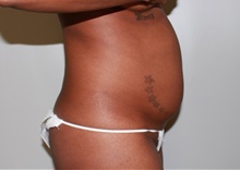 Liposuction Before Photo by John Menard, MD; Tuscaloosa, AL - Case 35926