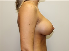 Breast Augmentation After Photo by John Menard, MD; Tuscaloosa, AL - Case 36635