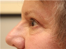 Eyelid Surgery After Photo by John Menard, MD; Tuscaloosa, AL - Case 36860