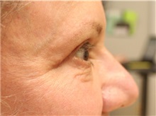Eyelid Surgery After Photo by John Menard, MD; Tuscaloosa, AL - Case 36860