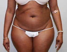 Liposuction Before Photo by John Menard, MD; Tuscaloosa, AL - Case 38389