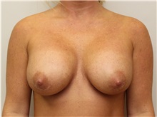 Breast Augmentation After Photo by John Menard, MD; Tuscaloosa, AL - Case 38390