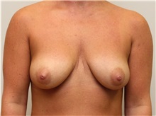 Breast Augmentation Before Photo by John Menard, MD; Tuscaloosa, AL - Case 38390