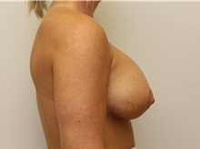 Breast Augmentation After Photo by John Menard, MD; Tuscaloosa, AL - Case 38390