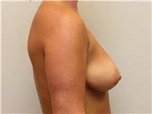 Breast Augmentation Before Photo by John Menard, MD; Tuscaloosa, AL - Case 38390