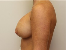 Breast Augmentation After Photo by John Menard, MD; Tuscaloosa, AL - Case 38390