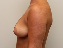 Breast Augmentation Before Photo by John Menard, MD; Tuscaloosa, AL - Case 38390