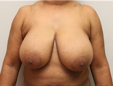 Breast Reduction Before Photo by John Menard, MD; Tuscaloosa, AL - Case 38392