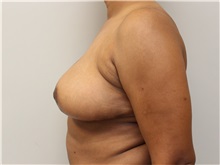 Breast Reduction After Photo by John Menard, MD; Tuscaloosa, AL - Case 38392