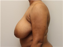 Breast Reduction Before Photo by John Menard, MD; Tuscaloosa, AL - Case 38392