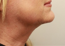 Liposuction After Photo by John Menard, MD; Tuscaloosa, AL - Case 38400