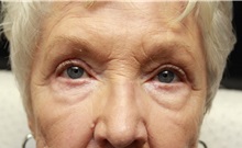 Eyelid Surgery After Photo by John Menard, MD; Tuscaloosa, AL - Case 38401