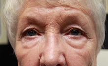 Eyelid Surgery Before Photo by John Menard, MD; Tuscaloosa, AL - Case 38401