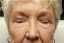 Eyelid Surgery After Photo by John Menard, MD; Tuscaloosa, AL - Case 38401