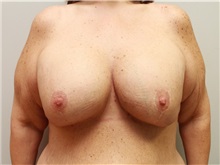 Breast Augmentation After Photo by John Menard, MD; Tuscaloosa, AL - Case 38403