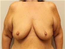 Breast Augmentation Before Photo by John Menard, MD; Tuscaloosa, AL - Case 38403