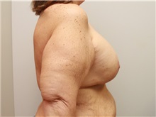 Breast Augmentation After Photo by John Menard, MD; Tuscaloosa, AL - Case 38403