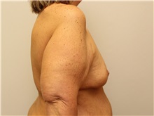 Breast Augmentation Before Photo by John Menard, MD; Tuscaloosa, AL - Case 38403