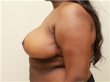 Breast Reduction After Photo by John Menard, MD; Tuscaloosa, AL - Case 38404