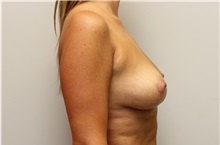 Breast Lift After Photo by John Menard, MD; Tuscaloosa, AL - Case 38405
