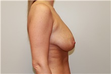 Breast Lift Before Photo by John Menard, MD; Tuscaloosa, AL - Case 38405