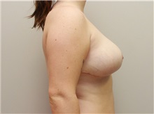 Breast Reduction After Photo by John Menard, MD; Tuscaloosa, AL - Case 38407