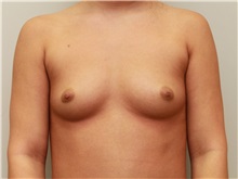 Breast Augmentation Before Photo by John Menard, MD; Tuscaloosa, AL - Case 38408