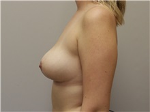 Breast Lift After Photo by John Menard, MD; Tuscaloosa, AL - Case 38409