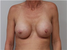 Breast Augmentation After Photo by John Menard, MD; Tuscaloosa, AL - Case 38410