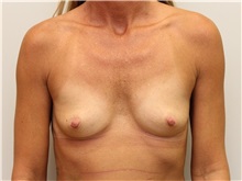 Breast Augmentation Before Photo by John Menard, MD; Tuscaloosa, AL - Case 38410
