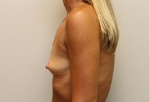 Breast Augmentation Before Photo by John Menard, MD; Tuscaloosa, AL - Case 38410