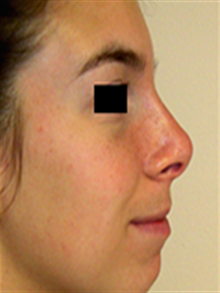 Rhinoplasty After Photo by Adrian Lo, MD; Philadelphia, PA - Case 27387