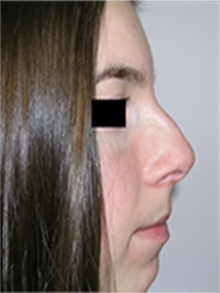Rhinoplasty Before Photo by Adrian Lo, MD; Philadelphia, PA - Case 27387