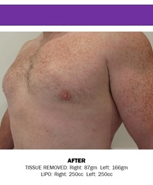 Male Breast Reduction After Photo by Adrian Lo, MD; Philadelphia, PA - Case 30614