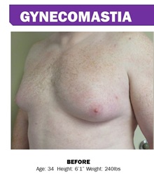 Male Breast Reduction Before Photo by Adrian Lo, MD; Philadelphia, PA - Case 30614