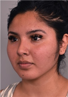 Cheek Reduction After Photo by Thomas Sterry, MD; New York, NY - Case 37063