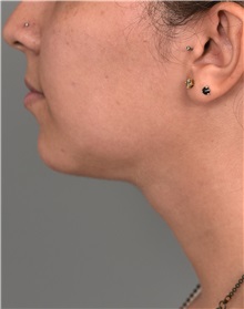 Cheek Reduction After Photo by Thomas Sterry, MD; New York, NY - Case 37065