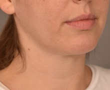 Cheek Reduction After Photo by Thomas Sterry, MD; New York, NY - Case 37066