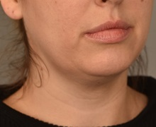 Cheek Reduction Before Photo by Thomas Sterry, MD; New York, NY - Case 37066