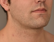 Cheek Reduction After Photo by Thomas Sterry, MD; New York, NY - Case 37067