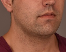 Cheek Reduction Before Photo by Thomas Sterry, MD; New York, NY - Case 37067