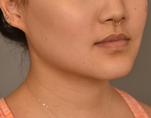 Cheek Reduction After Photo by Thomas Sterry, MD; New York, NY - Case 37069