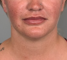 Cheek Reduction After Photo by Thomas Sterry, MD; New York, NY - Case 37070