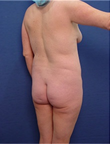 Liposuction Before Photo by Arian Mowlavi, MD; Laguna Beach, CA - Case 34050