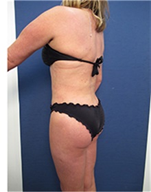 Liposuction After Photo by Arian Mowlavi, MD; Laguna Beach, CA - Case 34050