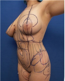 Liposuction Before Photo by Arian Mowlavi, MD; Laguna Beach, CA - Case 34057
