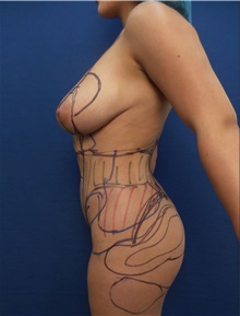 Liposuction Before Photo by Arian Mowlavi, MD; Laguna Beach, CA - Case 34057