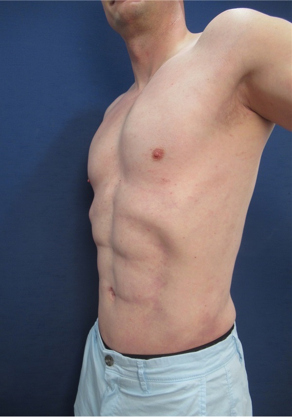 Liposuction Before and After Photos by Arian Mowlavi, MD